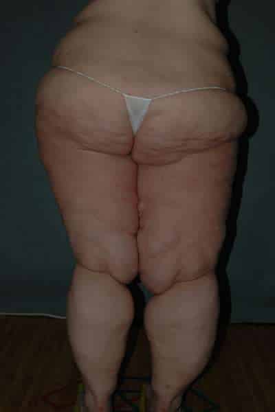 Thigh Lift