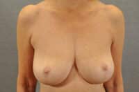 Breast Lift