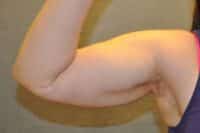 Arm Lift