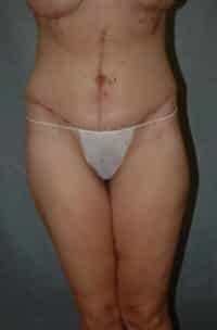 Belt Lipectomy
