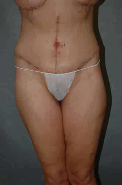 Belt Lipectomy