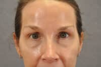 Brow lift