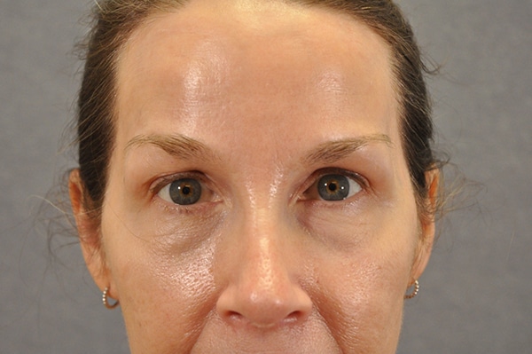Brow lift