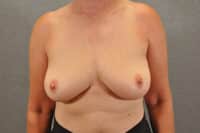 Breast Implant Removal