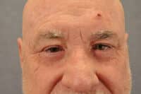 Male Eyelid Lift