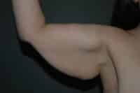 Arm Lift
