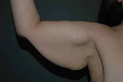 Arm Lift