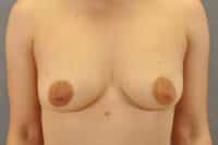 Nipple Correction