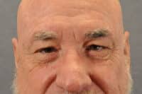 Male Eyelid Lift