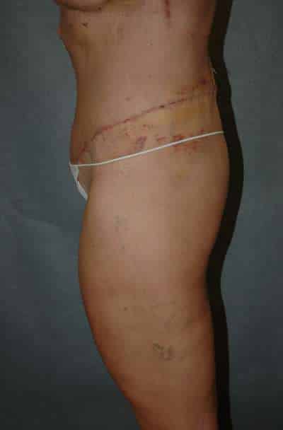 Belt Lipectomy
