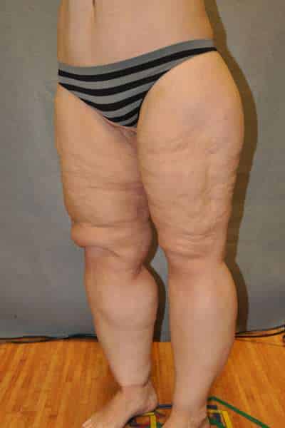 Thigh Lift