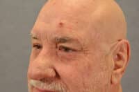 Male Eyelid Lift