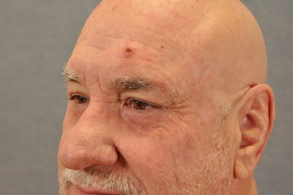 Male Eyelid Lift