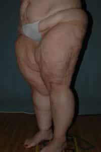 Thigh Lift