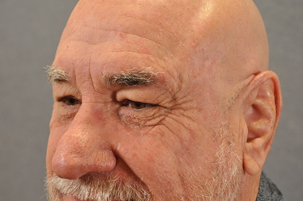 Male Eyelid Lift