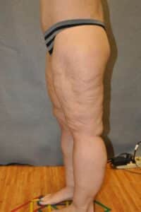 Thigh Lift