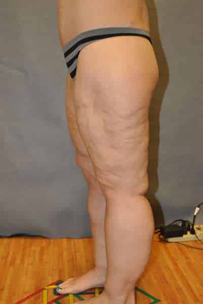 Thigh Lift