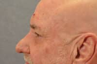 Male Eyelid Lift