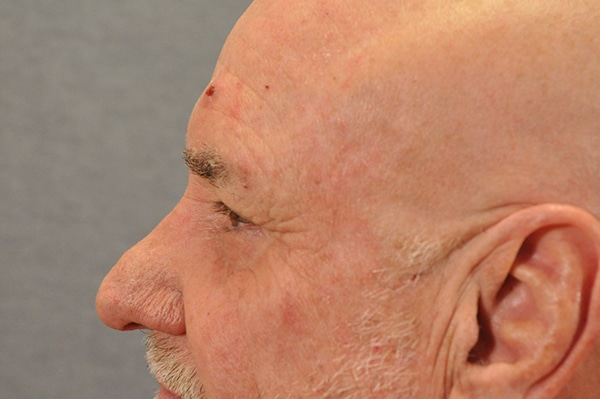 Male Eyelid Lift