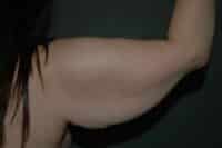 Arm Lift