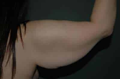 Arm Lift