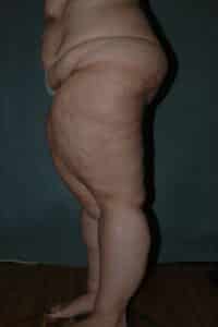 Thigh Lift