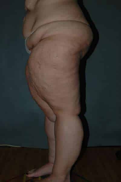 Thigh Lift