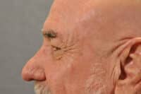 Male Eyelid Lift