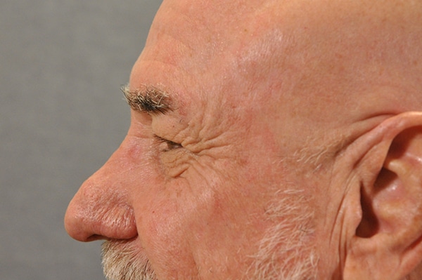 Male Eyelid Lift