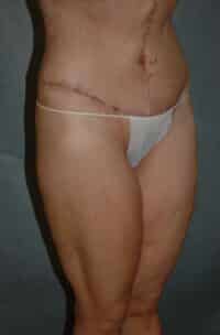 Belt Lipectomy