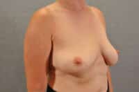 Breast Implant Removal