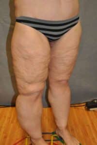 Thigh Lift