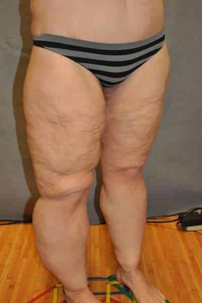 Thigh Lift