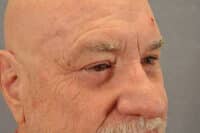Male Eyelid Lift