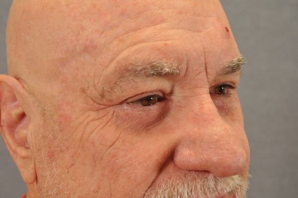 Male Eyelid Lift