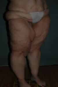 Thigh Lift