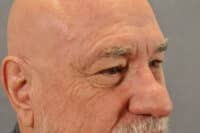 Male Eyelid Lift