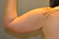 Arm Lift