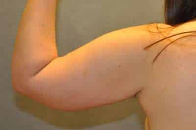 Arm Lift