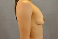 Nipple Correction
