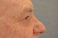 Male Eyelid Lift