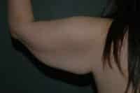 Arm Lift