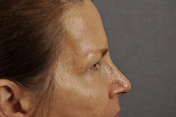 Brow lift