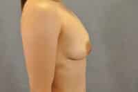 Nipple Correction