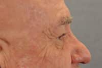 Male Eyelid Lift