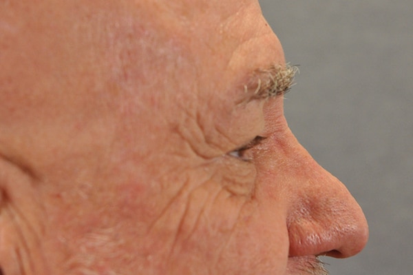 Male Eyelid Lift