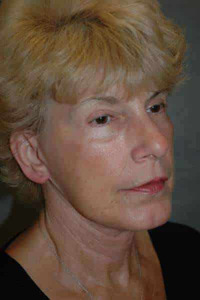 Facelift