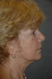 Facelift