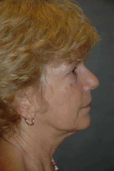 Facelift