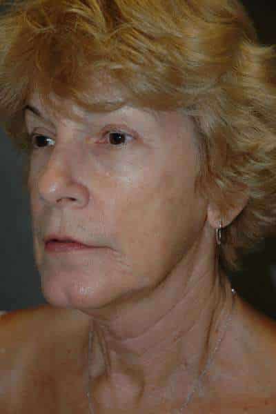 Facelift